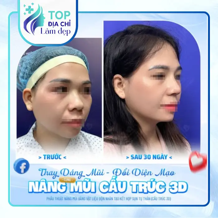 Khám Phá Top 7+ Địa Chỉ Nâng Mũi Uy Tín & Được Đánh Giá Cao Nhất Tại An Giang