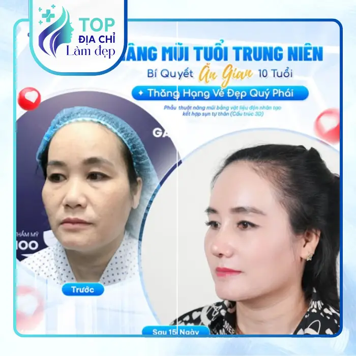 Khám Phá Top 7+ Địa Chỉ Nâng Mũi Đáng Tin Cậy, An Toàn Hàng Đầu Tại Bình Dương