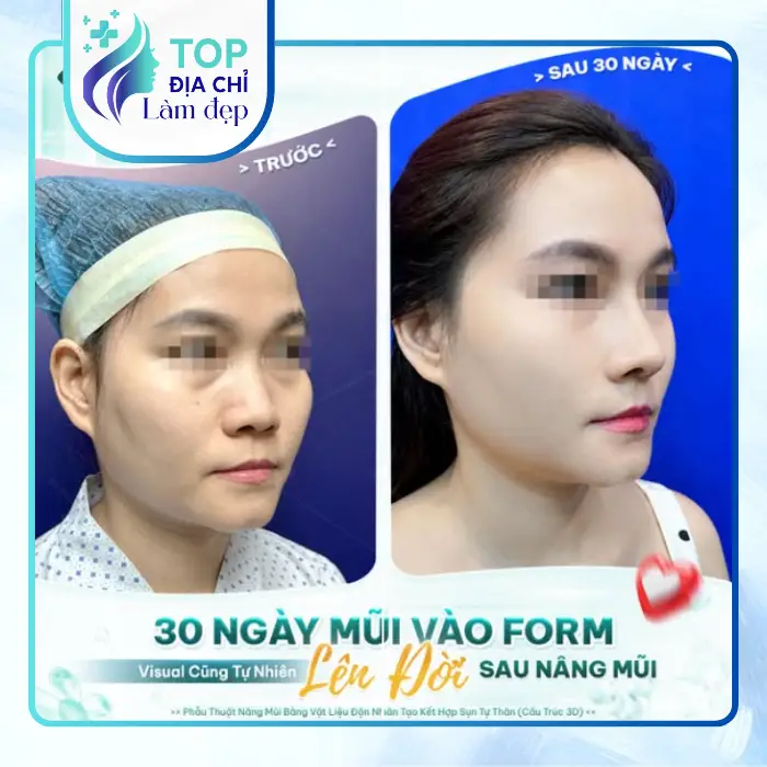 Tổng Hợp 7 Địa Chỉ Nâng Mũi Tại Cần Thơ Được Nhiều Người Review