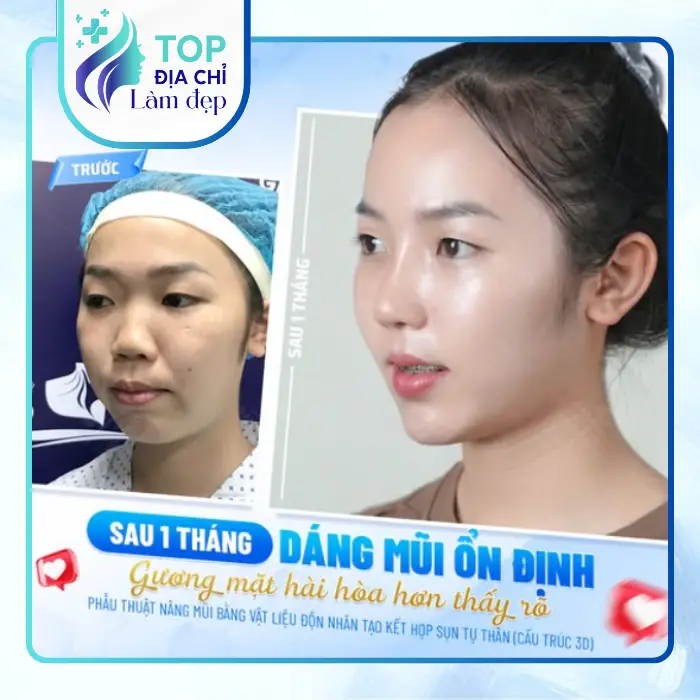 Tổng Hợp 7 Địa Chỉ Nâng Mũi Tại Cần Thơ Được Nhiều Người Review