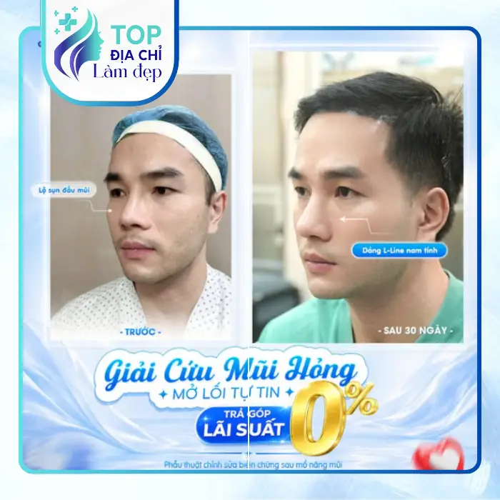 Top 7 Địa Chỉ Nâng Mũi Tại Gia Lai Lựa Chọn Đáng Tin Cậy Cho Mũi Đẹp