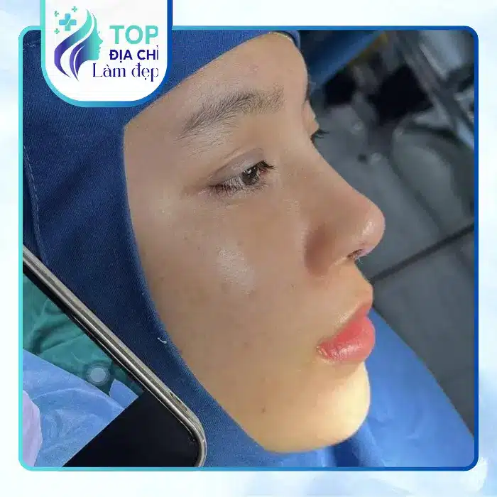 Nâng mũi tại Thái Nguyên: Những điều cần biết khi nâng mũi