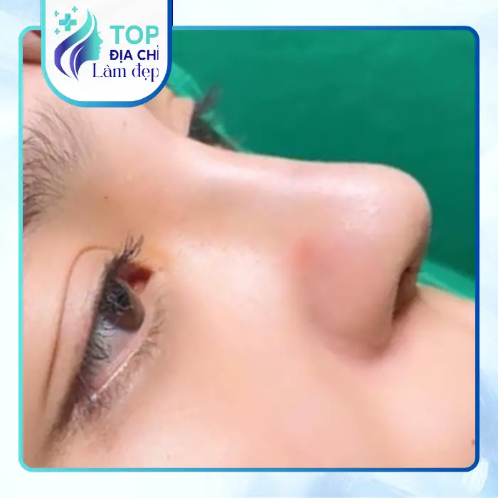 Nâng mũi tại Thái Nguyên: Những điều cần biết khi nâng mũi