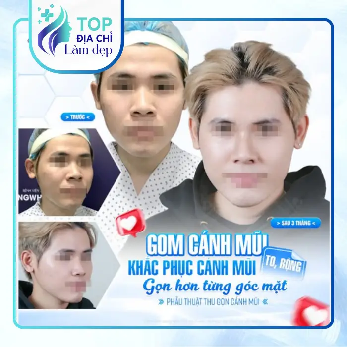 Nâng Mũi Uy Tín Tại Phú Yên: Lựa Chọn Địa Chỉ Thẩm Mỹ An Toàn, Hiện Đại Cho Vẻ Đẹp Tự Nhiên