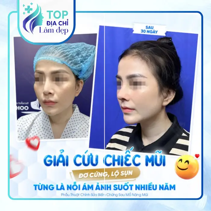 Nâng Mũi Uy Tín Tại Sóc Trăng: Lựa Chọn Hoàn Hảo Cho Vẻ Đẹp Tự Nhiên