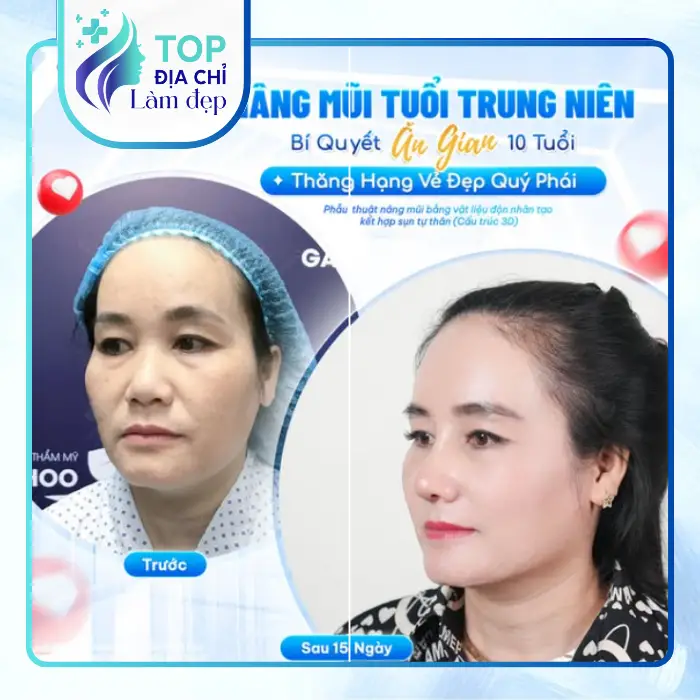 Nâng mũi tại Thái Bình Và Những Rủi Ro Cần Tránh