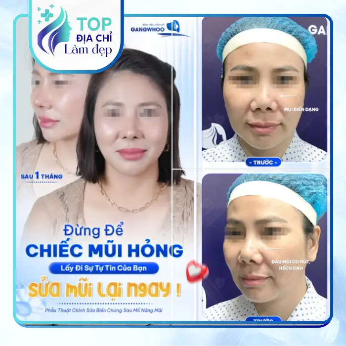 Nâng Mũi Uy Tín Tại Quảng Ngãi Hướng Dẫn Chi Tiết Và Danh Sách Địa Chỉ An Toàn