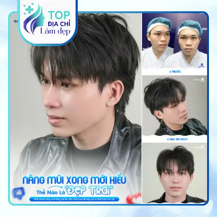 Top 5 địa chỉ nâng mũi chất lượng tại Tuyên Quang