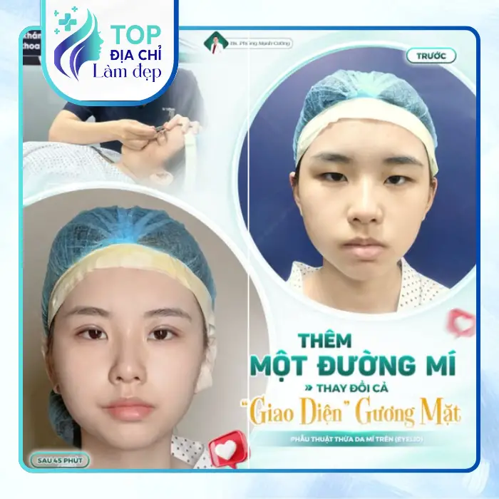 7 Địa Điểm Nâng Mí Mắt Tại TP.HCM Được Tin Tưởng Nhiều Hiện Nay