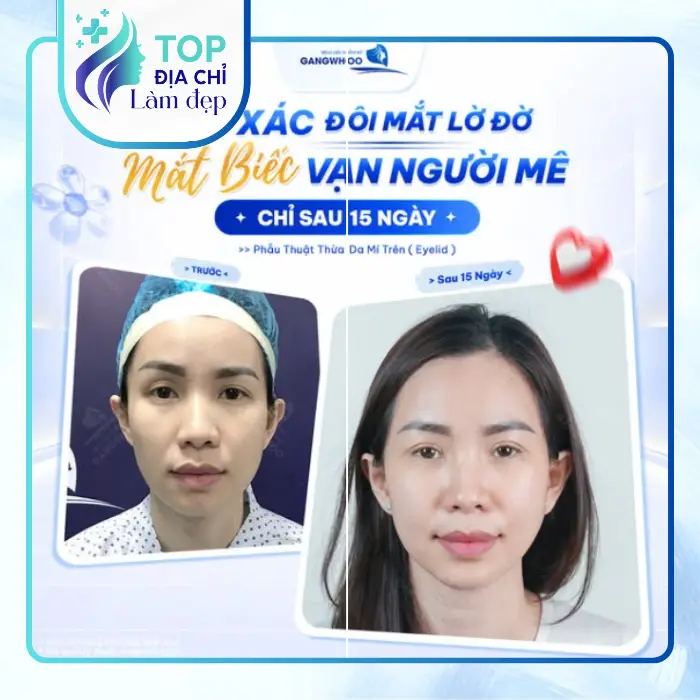 7 Địa Điểm Nâng Mí Mắt Tại TP.HCM Được Tin Tưởng Nhiều Hiện Nay