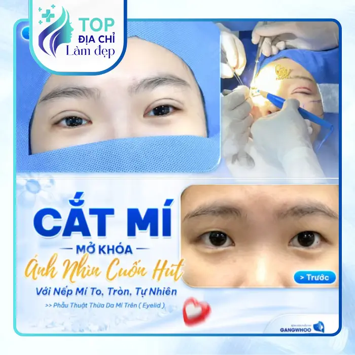 Top 6 địa chỉ cắt mí mắt tại Bắc Ninh đẹp tự nhiên, an toàn nhất hiện nay