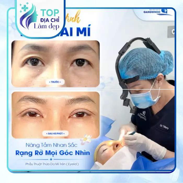Top 7 Địa Chỉ Cắt Mí Mắt Tại Đắk Lắk Uy Tín, Chất Lượng