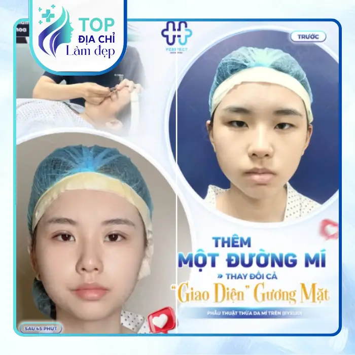 Cắt Mí Mắt Tại An Giang: 7 Địa Chỉ Uy Tín, An Toàn Nên Quan Tâm