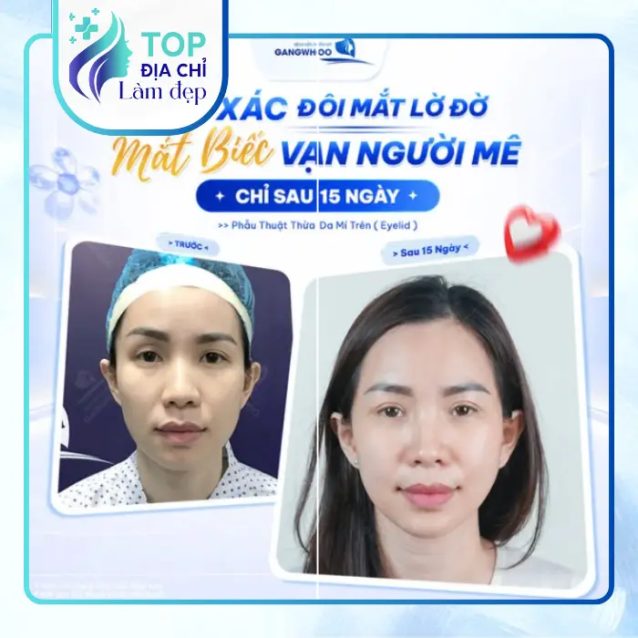 Top 7 Cơ Sở Cắt Mí Mắt Tại Đồng Nai Chất Lượng Hàng Đầu