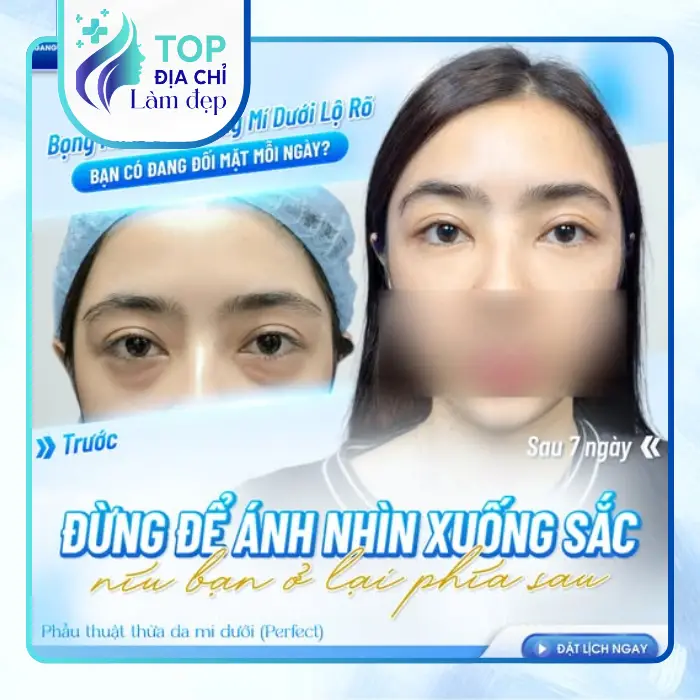 7 Cơ Sở Cắt Mí Mắt Tại Hà Tĩnh An Toàn, Uy Tín