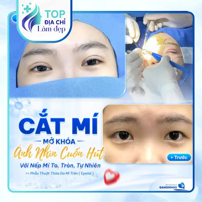 Top 5 cơ sở cắt mí mắt tại Hòa Bình uy tín
