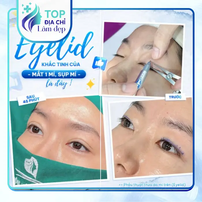 Review 5 cơ sở cắt mí mắt tại Khánh Hòa chất lượng