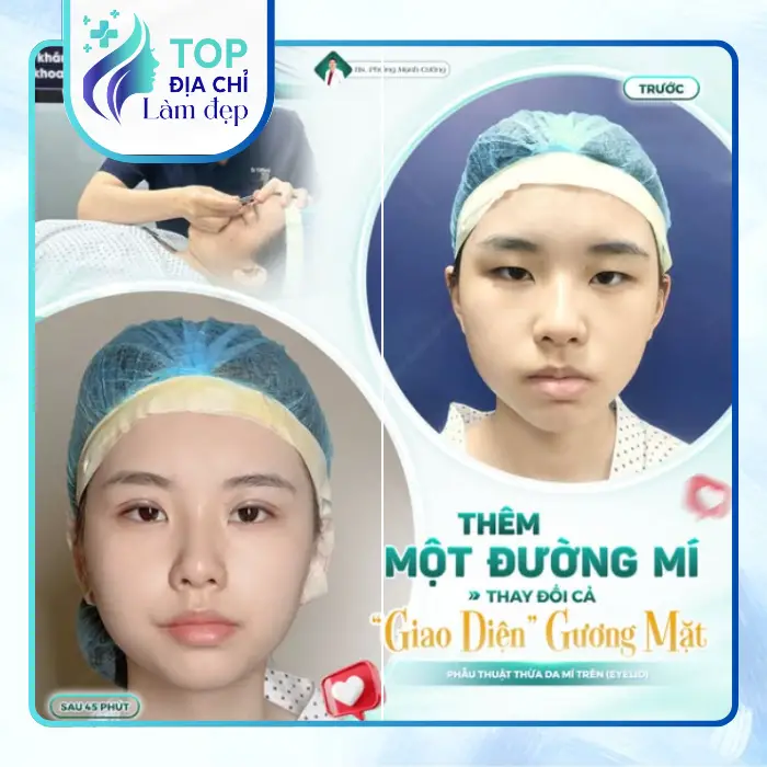 Top 5 địa chỉ nhấn mí, cắt mí được nhiều khách hàng tin chọn tại Lai Châu