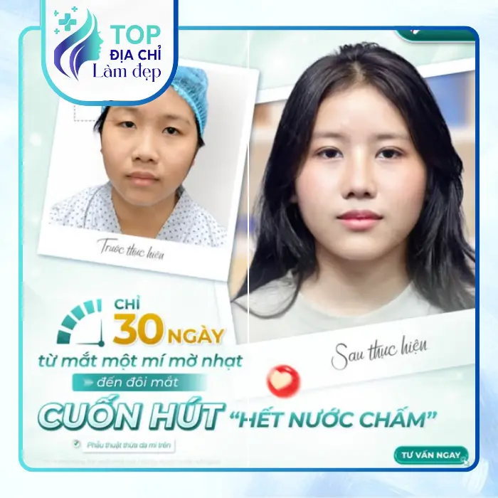Danh sách 5 cơ sở cắt mí mắt uy tín tại Ninh Bình