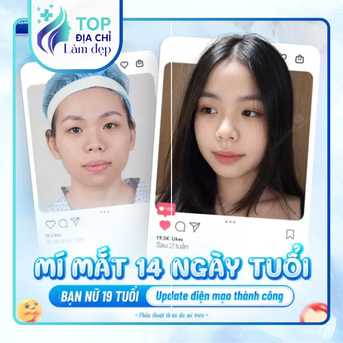 Địa chỉ top 5 cắt mí mắt tốt nhất tại Phú Thọ bạn nên biết