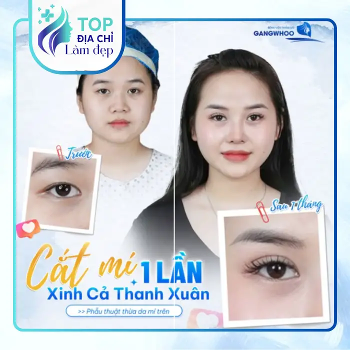 Cắt mí mắt ở đâu đẹp tại Quảng Ninh? Gợi ý 5 địa chỉ uy tín