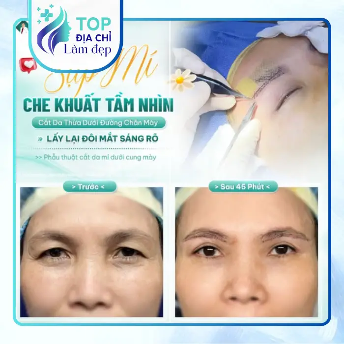 Top 5 địa chỉ cắt mí mắt tại Thái Nguyên – mắt hai mí tự nhiên, an toàn