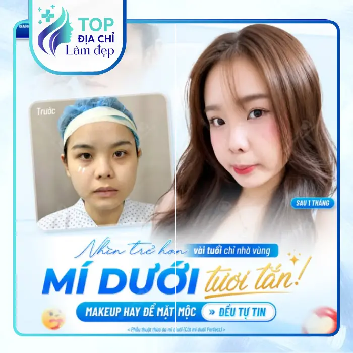 Top 6 Địa Chỉ Cắt Mí Mắt Tại Thanh Hóa Uy Tín, Đẹp Tự Nhiên