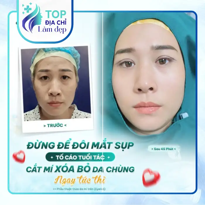 Top Địa Chỉ Cắt Mí Mắt Tại Quận 10 Uy Tín, Bác Sĩ Giỏi & An Toàn