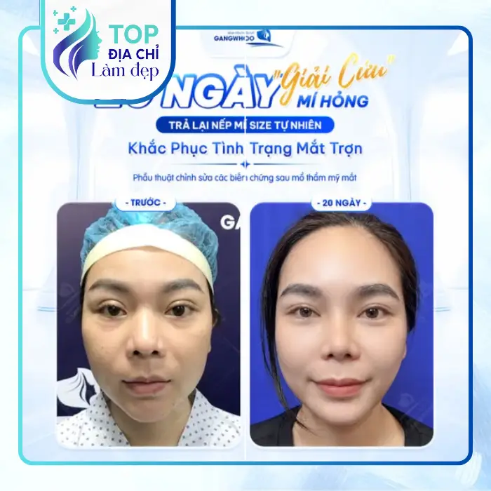 Top Địa Chỉ Cắt Mí Mắt Tại Quận 10 Uy Tín, Bác Sĩ Giỏi & An Toàn