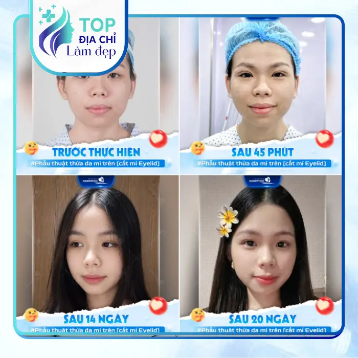 Cắt mí mắt tại Tuyên Quang – 7 Địa chỉ uy tín, đẹp tự nhiên, an toàn