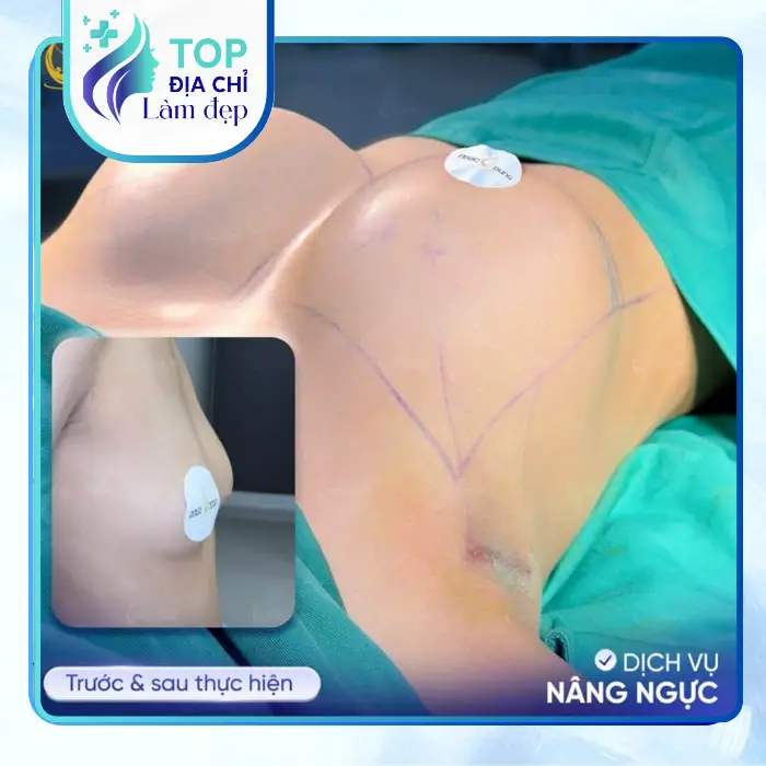 Top 5 Địa Chỉ Nâng Ngực Tại An Giang Uy Tín, Được Nhiều Khách Hàng Quan Tâm