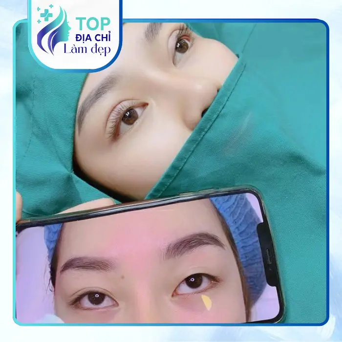 Cắt Mí Mắt Tại Quận Tân Phú – Top 4 Địa Chỉ Uy Tín, Đẹp Tự Nhiên