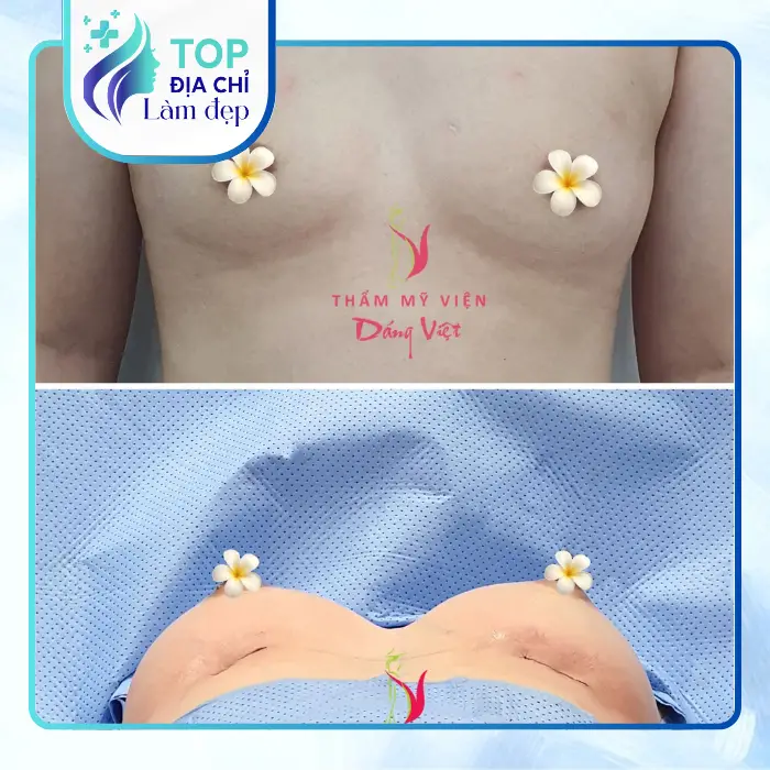 nâng ngực tại Cần Thơ