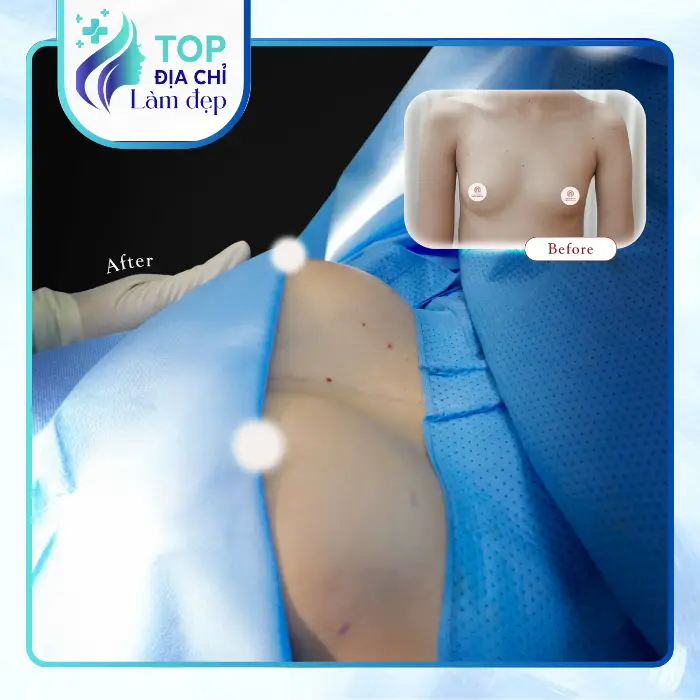 nâng ngực tại Cần Thơ