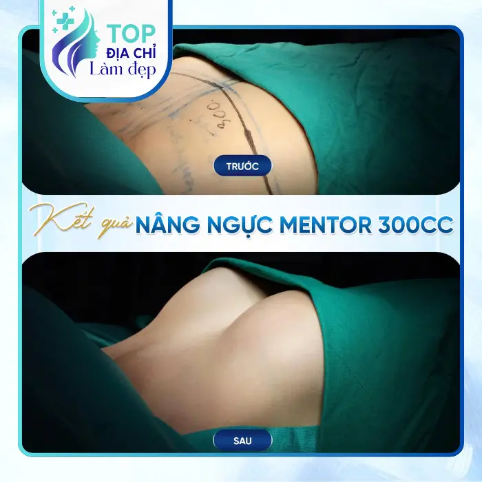 Nâng Ngực Tại Nghệ An Ở Đâu Uy Tín? Gợi Ý 4 Địa Chỉ Được Nhiều Chị Em Quan Tâm