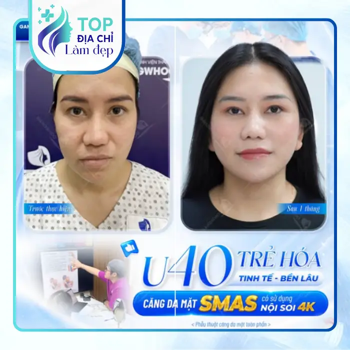 Gợi Ý Top 5 Địa Chỉ Căng Da Mặt Tại Đồng Tháp