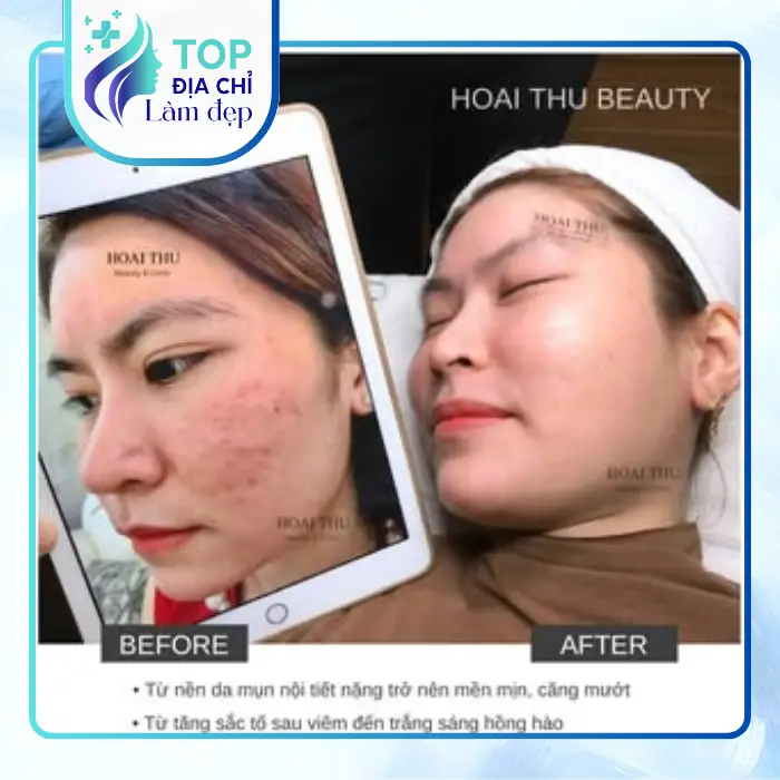 Căng Da Mặt Tại Thái Nguyên 3 Địa Chỉ Chăm Sóc Da Và Trẻ Hóa Khuôn Mặt