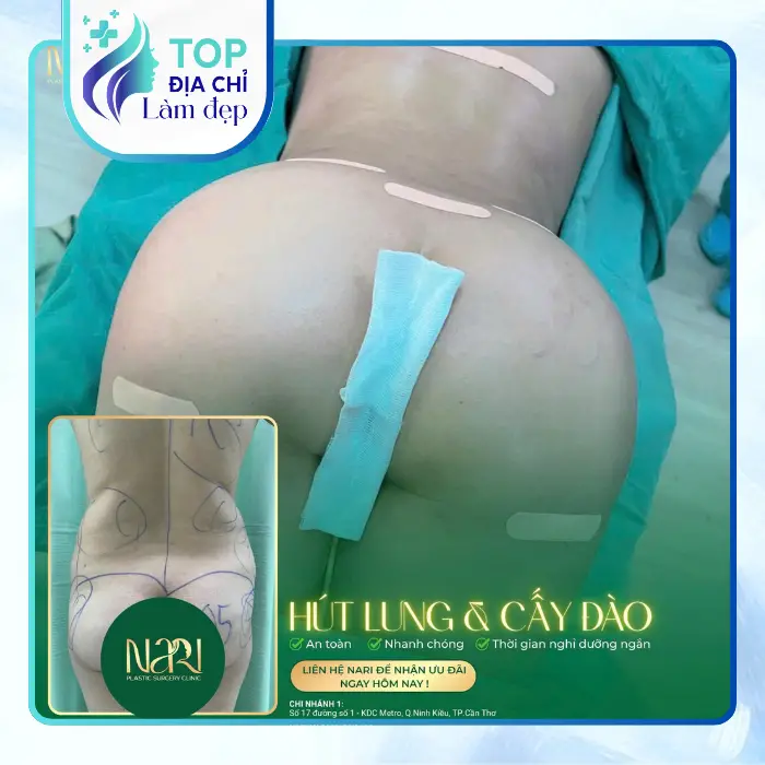 Nâng Mông Tại Cần Thơ – Gợi Ý 6 Cơ Sở Có Thể Tham Khảo