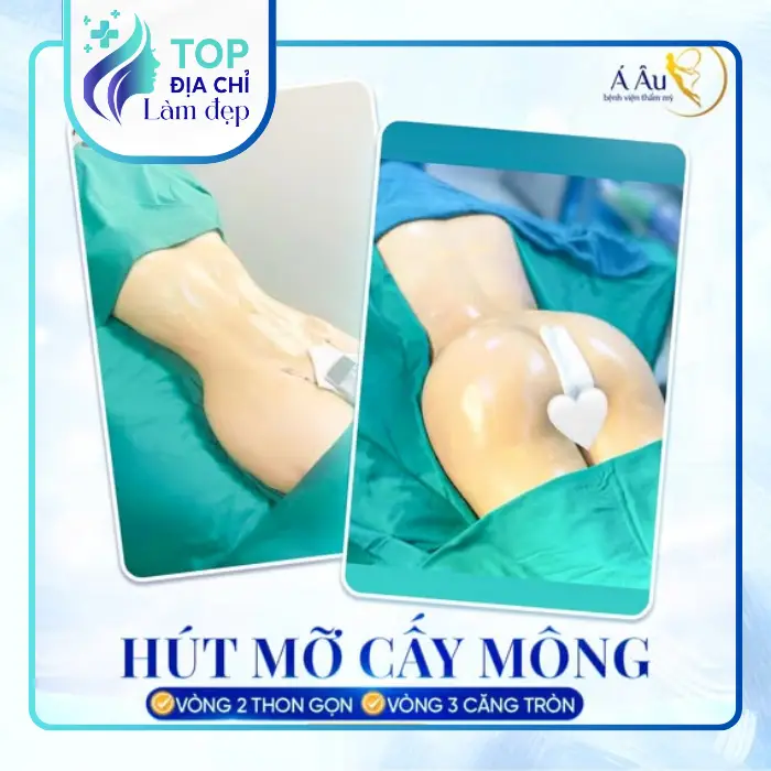 Nâng Mông Tại Hà Giang – Tham Khảo 8 Địa Chỉ Phẫu Thuật Tại TP.HCM