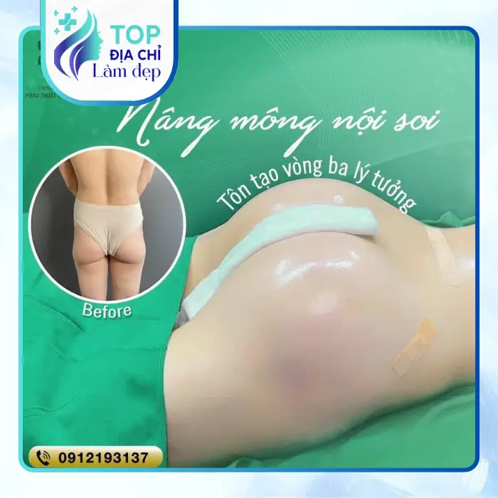 Nâng Mông Tại Nghệ An – Tham Khảo 4 Địa Chỉ Thẩm Mỹ
